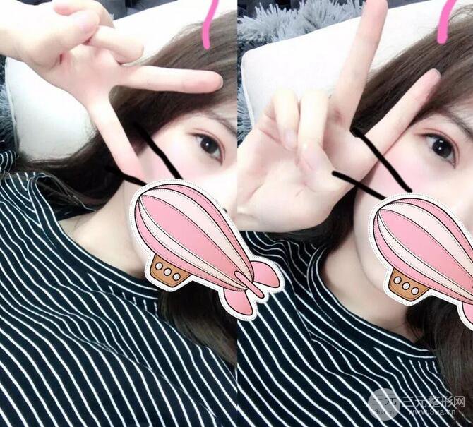 韩仕医美医院双眼皮技术如何?我想改变我这内双