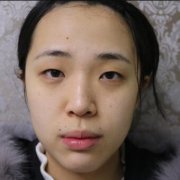 温州加美美容切开双眼皮对比图：拯救无神单眼皮~ width=
