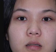 北京刘彦军韩式分段隆鼻案例：1-15天的变化对比图 width=