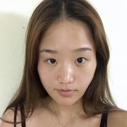 淮南华美切开双眼皮对比图：单眼皮变桃花眼的秘密武器 width=
