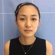 赵小忠面部注射除皱真人案例|赵小忠医生很靠谱！ width=