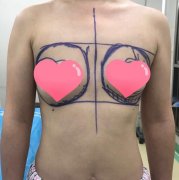石家庄雅芳亚直播隆胸恢复全过程对比~ width=