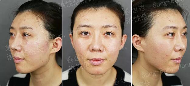 下颌角接骨整形技术
