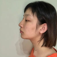 袁志玮肋软骨隆鼻的果如何?伊美尔鼻部整形专家是否名副其实