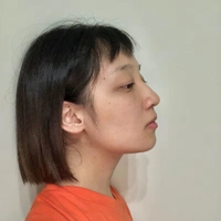 袁志玮肋软骨隆鼻的果如何?伊美尔鼻部整形专家是否名副其实