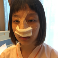 袁志玮肋软骨隆鼻的果如何?伊美尔鼻部整形专家是否名副其实