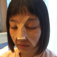 袁志玮肋软骨隆鼻的果如何?伊美尔鼻部整形专家是否名副其实