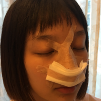 袁志玮肋软骨隆鼻的果如何?伊美尔鼻部整形专家是否名副其实