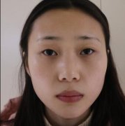 重庆当代整形术后75天割双眼皮对比图真人案例~ width=