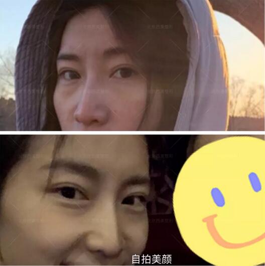 非手术眼袋消除有吗？我用亲身经历告诉你！