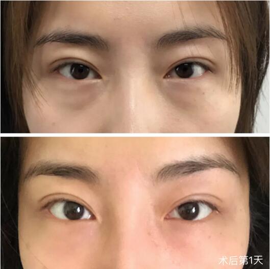 非手术眼袋消除有吗？我用亲身经历告诉你！