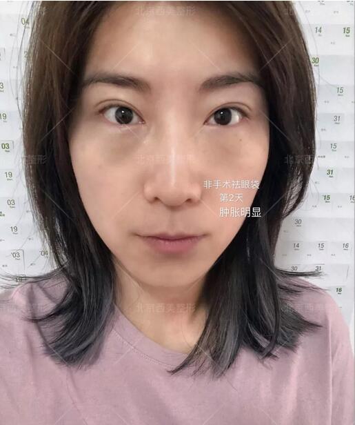 非手术眼袋消除有吗？我用亲身经历告诉你！