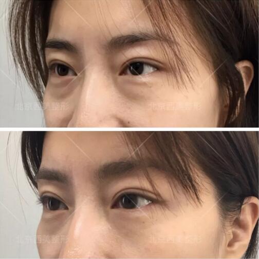 非手术眼袋消除有吗？我用亲身经历告诉你！