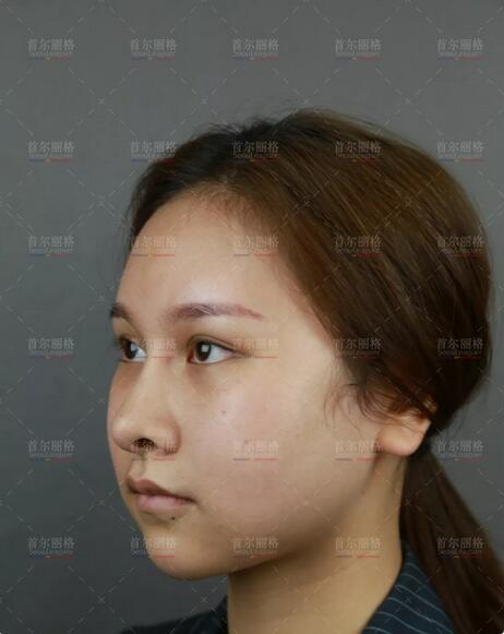 崔荣达长曲线下颌角手术+颊脂垫去除术+颧骨降低术+皮质骨切削术~