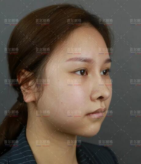 崔荣达长曲线下颌角手术+颊脂垫去除术+颧骨降低术+皮质骨切削术~