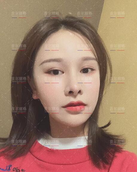 崔荣达长曲线下颌角手术+颊脂垫去除术+颧骨降低术+皮质骨切削术~
