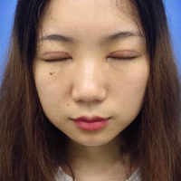 开眼角塑型成形 从此我的眯眯眼时代宣告结束