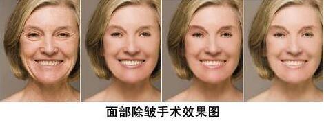 打瑞兰玻尿酸除皱多少钱?影响价格的因素有哪些?