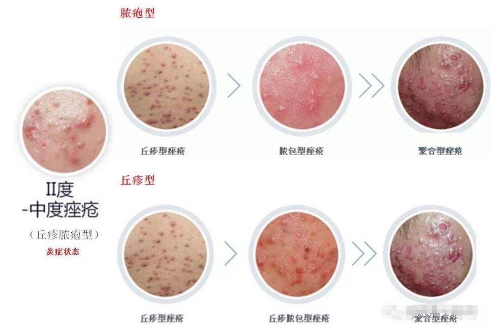 激光调节痤疮果好吗?术后该注意哪些?