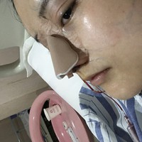 朱瑞峰鼻部手术技术如何?秃顶的他让我不是很放心