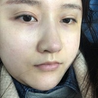 朱瑞峰鼻部手术技术如何?秃顶的他让我不是很放心