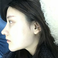 朱瑞峰鼻部手术技术如何?秃顶的他让我不是很放心