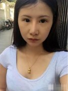去颊脂垫价格：一个真实去颊脂垫对比图片的案例 width=