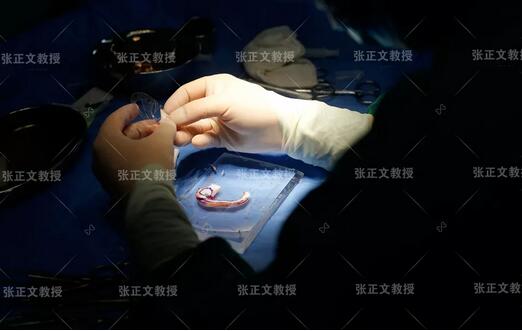 张正文教授谈“耳朵”：自体肋软骨再造的耳朵会吸收变形吗？