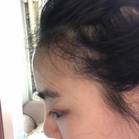 卢相勋植发技术如何?发际线太高让我很烦恼