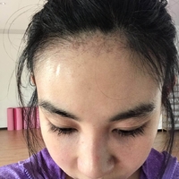 卢相勋植发技术如何?发际线太高让我很烦恼