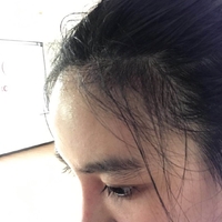 卢相勋植发技术如何?发际线太高让我很烦恼