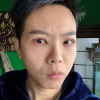 胡江伟做眼部手术果如何?历宁亲身案例为你解答