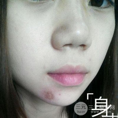 伊美尚祛疤果如何?不想再用口罩进行遮掩