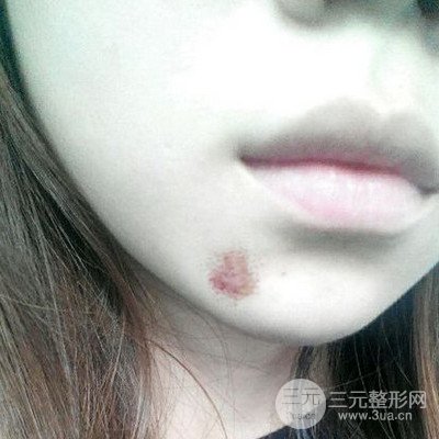 伊美尚祛疤果如何?不想再用口罩进行遮掩