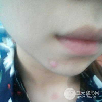 伊美尚祛疤果如何?不想再用口罩进行遮掩