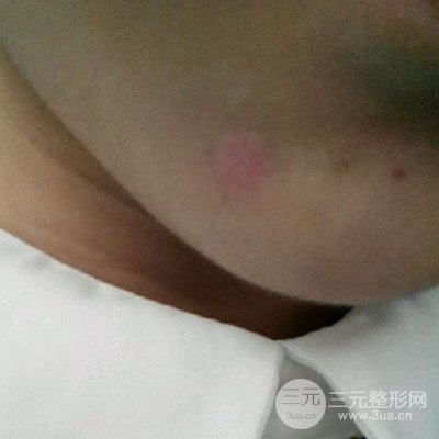 伊美尚祛疤果如何?不想再用口罩进行遮掩