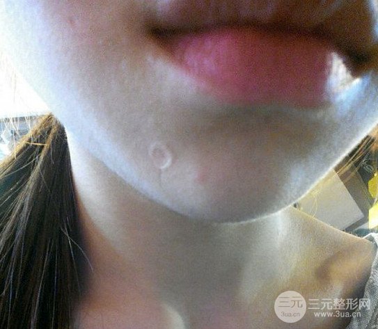 伊美尚祛疤果如何?不想再用口罩进行遮掩