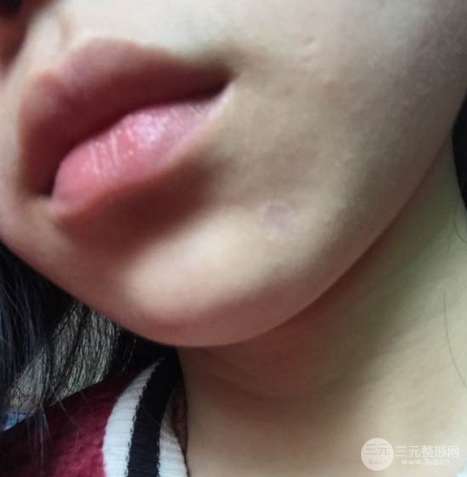 伊美尚祛疤果如何?不想再用口罩进行遮掩
