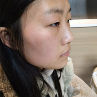 重庆真伊整形的重眼睑技术如何?能否让我拥有自然的双眼皮
