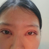 重庆真伊整形的重眼睑技术如何?能否让我拥有自然的双眼皮