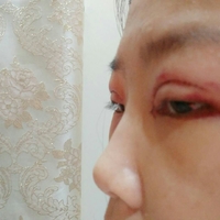 重庆真伊整形的重眼睑技术如何?能否让我拥有自然的双眼皮