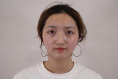 郑美善切开双眼皮+开内眼角前后对比图：转身就是你高攀不起的人 width=