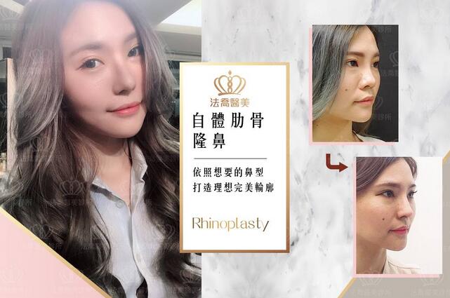 柳相旭自体肋软骨隆鼻+缩鼻翼案例分享，果还阔以~