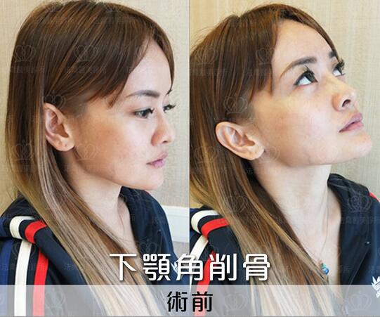 下颌角接骨整形技术