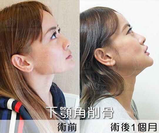 下颌角接骨整形技术