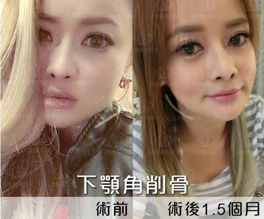 下颌角接骨整形技术