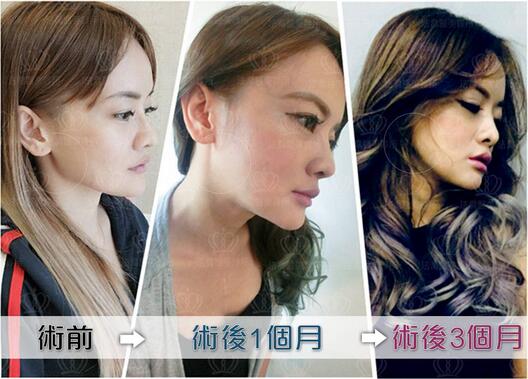 下颌角接骨整形技术