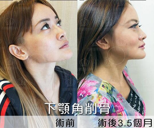 下颌角接骨整形技术
