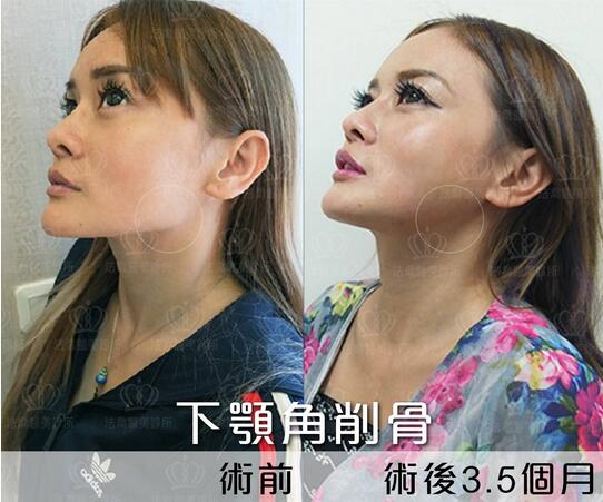 下颌角接骨整形技术