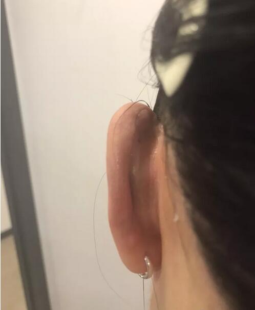 耳部再造手术有风险吗？